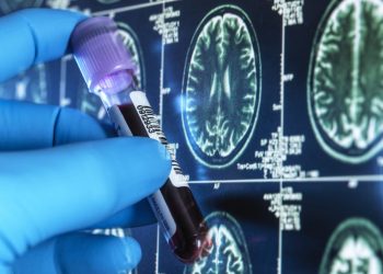 Alzheimer’ı tespit etmek için kan testi geliştirildi