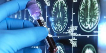 Alzheimer’ı tespit etmek için kan testi geliştirildi