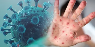 50 yaş üstü için ‘Maymun çiçeği’ uyarısı
