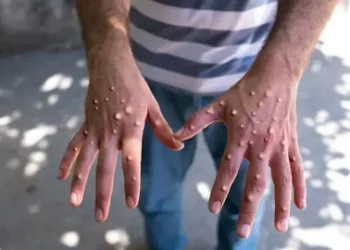 Pakistan’da da maymun çiçeği virüsü tespit edildi