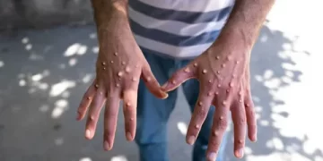 Pakistan’da da maymun çiçeği virüsü tespit edildi