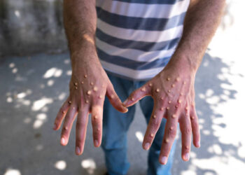 ‘Ankara’da maymun çiçeği virüsü görüldü’ iddialarına İl Sağlık Müdürlüğü’nden yalanlama