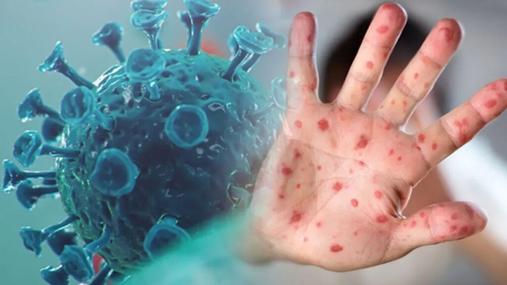 Hindistan’da ilk maymun çiçeği vakası maymun cicegi virusu habermeydan