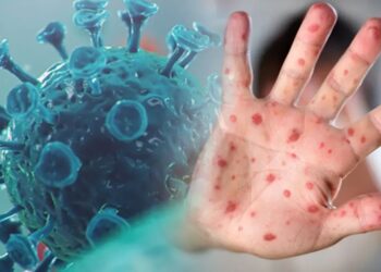 Hindistan’da ilk maymun çiçeği vakası