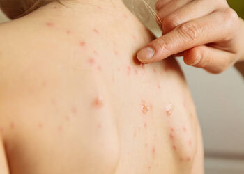 Zona Hastalığı (Gece Yanığı) Nedir? Zona Belirtileri, Nedenleri ve Tedavisi