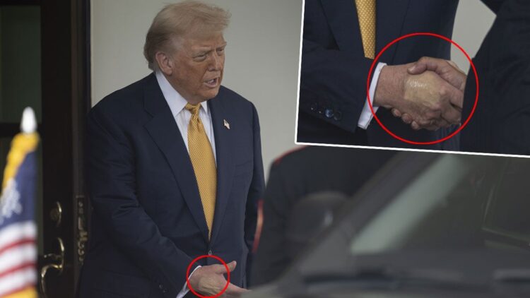 Trump'ın vücudundaki şişlik ve morluklarla ilgili Beyaz Saray'dan açıklama geldi.