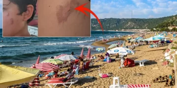 Deniz keyfi kabusa döndü: Kaşıntı ve yanmanın nedeni bulundu