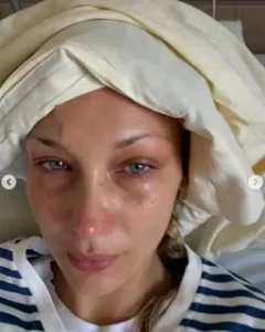 Bella Hadid hastaligi nedir3 habermeydan