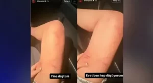 dilan polat darp izlerini paylasip sildi1 habermeydan